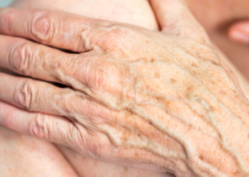 揭秘老年斑的真相！營養、護理與防曬的秘訣大公開