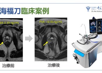 奇美醫院海福刀無創手術-結合即時影像-精準摧毀癌細胞