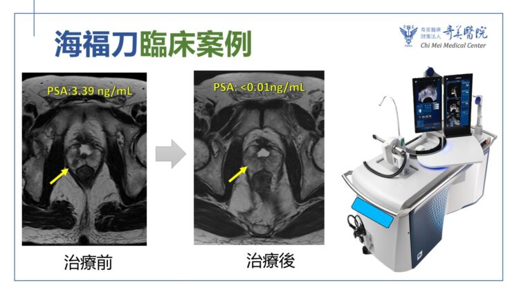 奇美醫院海福刀無創手術 結合即時影像 精準摧毀癌細胞 奇美醫院海福刀無創手術-結合即時影像-精準摧毀癌細胞