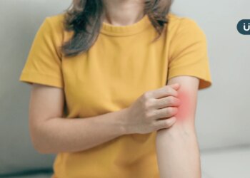 「紅斑性狼瘡」好發年輕女性！帶你揪出「8大警訊」從頭到腳都難逃