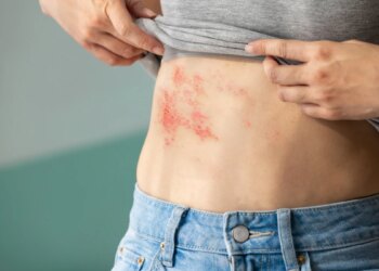 中醫顧護免疫力-預防帶狀皰疹