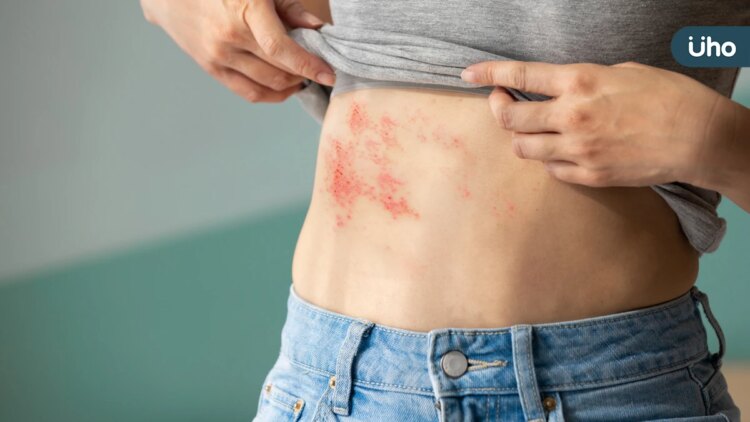 中醫顧護免疫力-預防帶狀皰疹