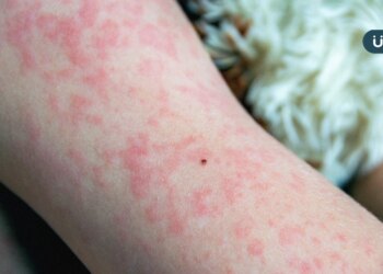 麻疹症狀有哪些？出現1症狀與感冒最不同：外觀如「鹽粒灑在紅肉上」