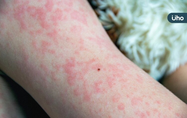 麻疹症狀有哪些?出現1症狀與感冒最不同:外觀如「鹽粒灑在紅肉上」 麻疹症狀有哪些?出現1症狀與感冒最不同:外觀如「鹽粒灑在紅肉上」