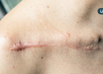 傷口留疤腫痛、搔癢⋯蟹足腫怎麼消除？皮膚科醫列「5種常見治療」