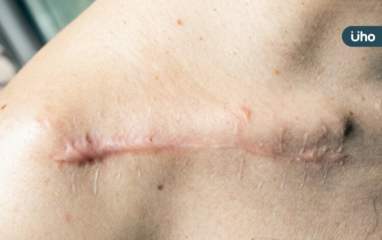 傷口留疤腫痛、搔癢⋯蟹足腫怎麼消除?皮膚科醫列「5種常見治療」 傷口留疤腫痛、搔癢⋯蟹足腫怎麼消除?皮膚科醫列「5種常見治療」