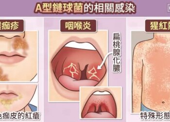 水腫、血尿⋯竟是細菌感染害「腎臟發炎」！醫揪「4大症狀」快就醫