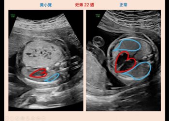 胎兒「腫瘤塞滿7成肺」險早產！一出生即「開刀切肺」北榮成功救命