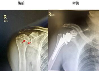 反置肩關節換術創奇蹟-八旬翁重燃網球冠軍夢