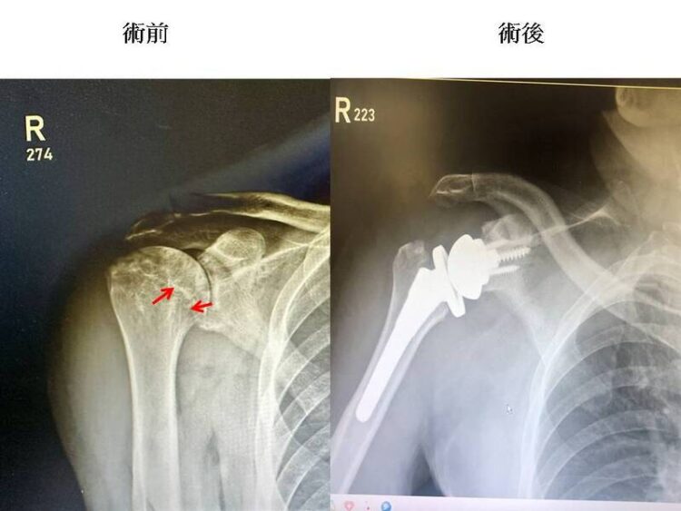 反置肩關節換術創奇蹟 八旬翁重燃網球冠軍夢 反置肩關節換術創奇蹟-八旬翁重燃網球冠軍夢