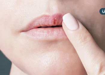 嘴唇冒出小水泡，小心唇皰疹找上你！醫列「5件事」千萬不可以做