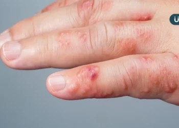手掌出現小水泡，小心汗皰疹發作！醫教「6招」預防：別直接摸肥皂