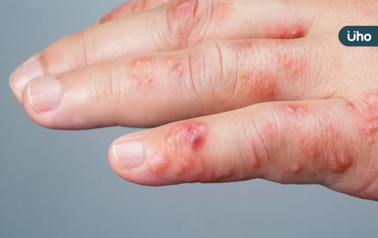 手掌出現小水泡,小心汗皰疹發作!醫教「6招」預防:別直接摸肥皂 手掌出現小水泡,小心汗皰疹發作!醫教「6招」預防:別直接摸肥皂