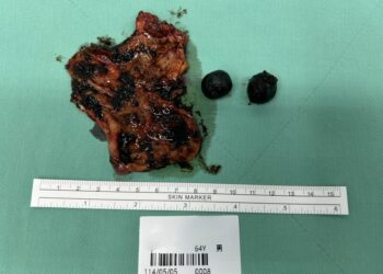 膽結石真會引發膽囊癌！ 全球罕見0.5%癌變機率發生在高雄男身上