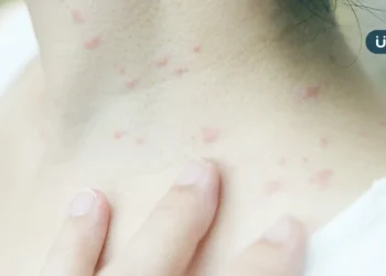 身上長膿包竟不是青春痘？醫揪「芽孢菌毛囊炎」1症狀與痘痘不同