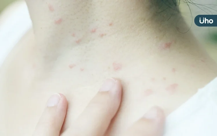身上長膿包竟不是青春痘？醫揪「芽孢菌毛囊炎」1症狀與痘痘不同