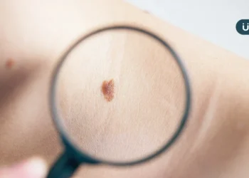 身上長痣是皮膚癌嗎？快速變大、凸起⋯當心「4類黑痣」恐長惡性腫瘤