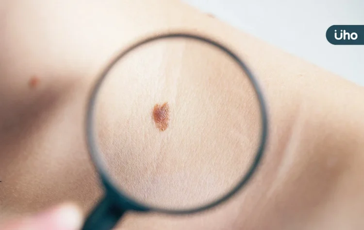 身上長痣是皮膚癌嗎?快速變大、凸起⋯當心「4類黑痣」恐長惡性腫瘤 身上長痣是皮膚癌嗎?快速變大、凸起⋯當心「4類黑痣」恐長惡性腫瘤