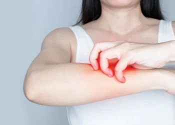 一換季全身癢爆？醫認證蕁麻疹「7大止癢攻略」這些食物先別吃