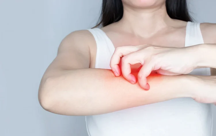 一換季全身癢爆?醫認證蕁麻疹「7大止癢攻略」這些食物先別吃 一換季全身癢爆?醫認證蕁麻疹「7大止癢攻略」這些食物先別吃