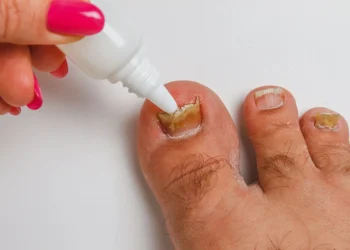 灰指甲跟香港腳有關？皮膚科醫揭好發族群：手部也可能被黴菌感染