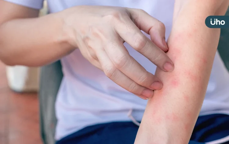 乾燥、皮疹⋯全身癢又痛!台大醫揭「異位性皮膚炎」恐是免疫失調 乾燥、皮疹⋯全身癢又痛!台大醫揭「異位性皮膚炎」恐是免疫失調