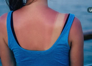 曬傷敷蘆薈、小黃瓜⋯恐害皮膚過敏發炎？醫授「正確皮膚保養」4招