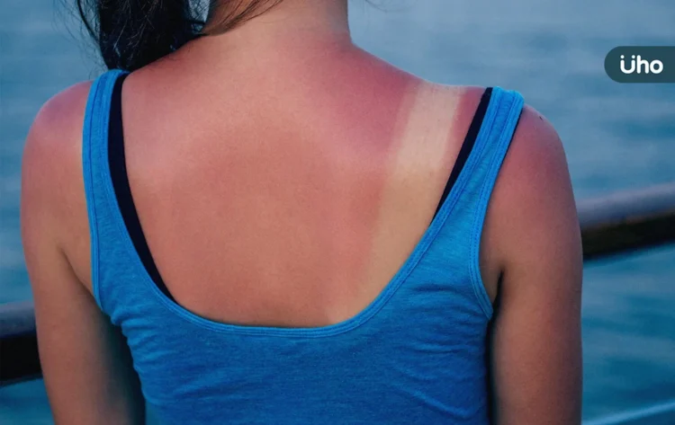 曬傷敷蘆薈、小黃瓜⋯恐害皮膚過敏發炎?醫授「正確皮膚保養」4招 曬傷敷蘆薈、小黃瓜⋯恐害皮膚過敏發炎?醫授「正確皮膚保養」4招