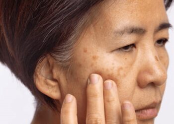 黑斑認識與日常保養觀念分享 肌膚諮詢與衛教資訊導向