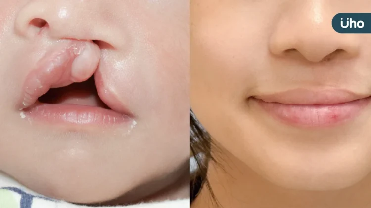 兔寶爸媽成長工作坊歷十屆有成 台灣唇顎裂產前診斷與產後治療典範轉移 兔寶爸媽成長工作坊歷十屆有成 台灣唇顎裂產前診斷與產後治療典範轉移