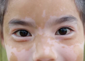 8歲女童患白斑症 醫病共同控制病情