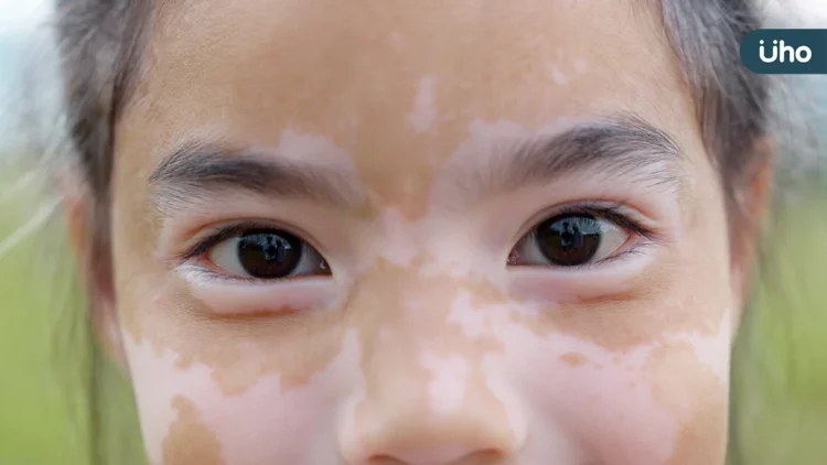 8歲女童患白斑症 醫病共同控制病情 8歲女童患白斑症 醫病共同控制病情