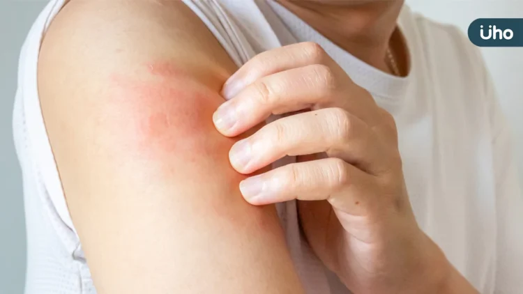 異膚治療不中斷！健保新藥想要「再上車」 病友該怎麼做？