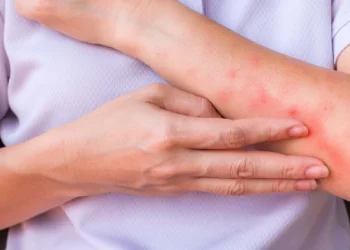 異位性皮膚炎治療新趨勢 生物製劑到生活調適 找回穩定自信 異位性皮膚炎治療新趨勢 生物製劑到生活調適 找回穩定自信