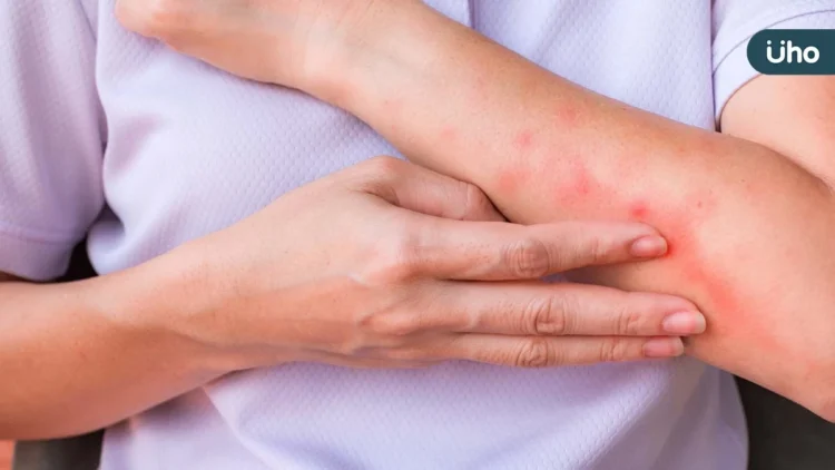 異位性皮膚炎治療新趨勢 生物製劑到生活調適 找回穩定自信 異位性皮膚炎治療新趨勢 生物製劑到生活調適 找回穩定自信