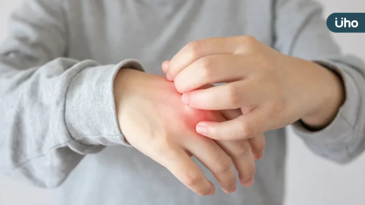 20歲男大生乾癬疾病延燒關節誤認痛風 醫籲提早控制發炎為關鍵 20歲男大生乾癬疾病延燒關節誤認痛風 醫籲提早控制發炎為關鍵