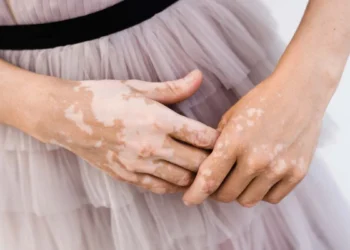 白斑少年被偷走「顏色」青春 醫:新一代標靶藥物找回「色彩」 白斑少年被偷走「顏色」青春 醫:新一代標靶藥物找回「色彩」