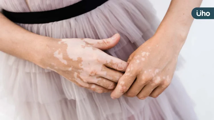 白斑少年被偷走「顏色」青春 醫：新一代標靶藥物找回「色彩」